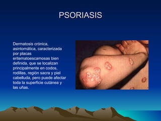 PSORIASIS Dermatosis crónica, asintomática, caracterizada por placas eritematoescamosas bien definida, que se localizan principalmente en codos, rodillas, región sacra y piel cabelluda, pero puede afectar toda la superficie cutánea y las uñas. 