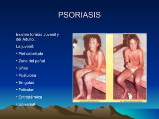 PSORIASIS Existen formas Juvenil y del Adulto.  La juvenil: Piel cabelluda Zona del pañal Uñas Pustulosa En gotas Folicular Eritrodérmica Universal 