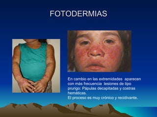 FOTODERMIAS En cambio en las extremidades  aparecen con más frecuencia  lesiones de tipo prurigo: Pápulas decapitadas y costras hemáticas.  El proceso es muy crónico y recidivante. 