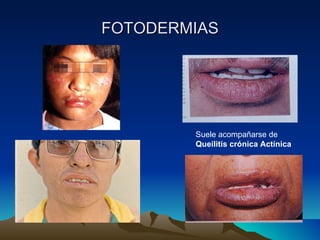 FOTODERMIAS Suele acompañarse de  Queilitis crónica Actínica 