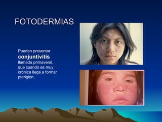 FOTODERMIAS Pueden presentar  conjuntivitis  llamada primaveral, que cuando es muy crónica llega a formar pterigion. 