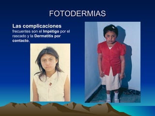FOTODERMIAS Las complicaciones  frecuentes son el  Impétigo  por el rascado y la  Dermatitis por contacto . 