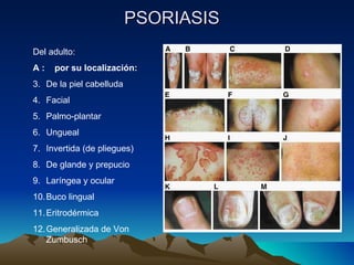 PSORIASIS Del adulto:  A :  por su localización: De la piel cabelluda Facial Palmo-plantar Ungueal Invertida (de pliegues) De glande y prepucio Laríngea y ocular Buco lingual Eritrodérmica Generalizada de Von Zumbusch 