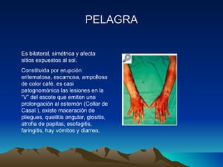 PELAGRA Es bilateral, simétrica y afecta sitios expuestos al sol. Constituida por erupción eritematosa, escamosa, ampollosa de color café, es casi patognomónica las lesiones en la “V” del escote que emiten una prolongación al esternón (Collar de Casal ), existe maceración de pliegues, queilitis angular, glositis, atrofia de papilas, esofagitis, faringitis, hay vómitos y diarrea. 