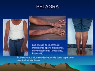 PELAGRA Las causas de la carencia: Insuficiente aporte nutricional, mayor necesidad (embarazo, Pubertad.) Problemas nutricionales derivados de daño hepático o intestinal, alcoholismo. 