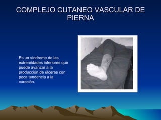 COMPLEJO CUTANEO VASCULAR DE PIERNA Es un síndrome de las extremidades inferiores que puede avanzar a la producción de úlceras con poca tendencia a la curación. 