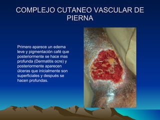 COMPLEJO CUTANEO VASCULAR DE PIERNA Primero aparece un edema leve y pigmentación café que posteriormente se hace mas profunda (Dermatitis ocre) y posteriormente aparecen úlceras que inicialmente son superficiales y después se hacen profundas. 