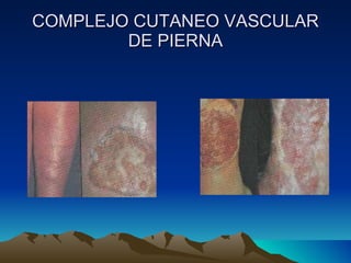 COMPLEJO CUTANEO VASCULAR DE PIERNA 