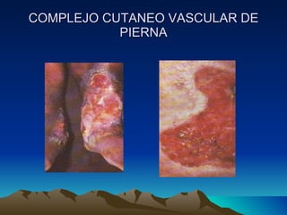 COMPLEJO CUTANEO VASCULAR DE PIERNA 