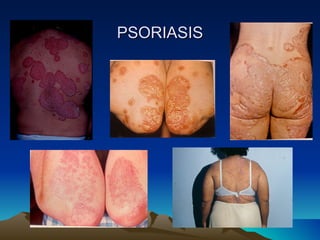 PSORIASIS 