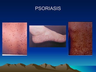 PSORIASIS 