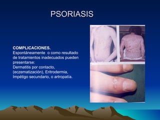 PSORIASIS COMPLICACIONES. Espontáneamente  o como resultado de tratamientos inadecuados pueden presentarse:  Dermatitis por contacto, (eczematización), Eritrodermia, Impétigo secundario, o artropatía. 