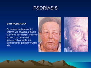 PSORIASIS ERITRODERMIA Es una generalización del eritema y la escama a toda la superficie del cuerpo, inclusive la cara, con mal estado general del paciente que siente intenso prurito y mucho frío. 