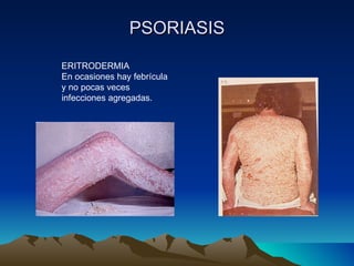 PSORIASIS ERITRODERMIA En ocasiones hay febrícula y no pocas veces infecciones agregadas. 