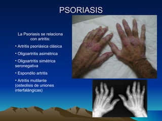 PSORIASIS La Psoriasis se relaciona con artritis: Artritis psoriásica clásica Oligoartritis asimétrica Oligoartritis simétrica seronegativa Espondilo artritis Artritis mutilante (osteolisis de uniones interfalángicas) 