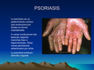 PSORIASIS La psoriasis es un padecimiento crónico que evoluciona por brotes en forma impredecible.  A veces involucionan las lesiones dejando manchas hipo o hipercrómicas. Otras veces permanece estacionaria por años. La psoriasis produce distrofia ungueal. 