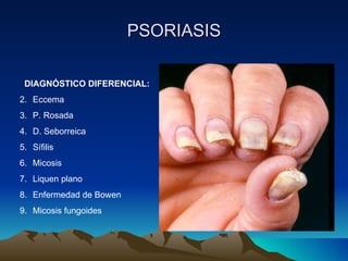 PSORIASIS DIAGNÓSTICO DIFERENCIAL: Eccema P. Rosada D. Seborreica Sífilis Micosis Liquen plano Enfermedad de Bowen Micosis fungoides 