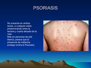 PSORIASIS Se presenta en ambos sexos, a cualquier edad, predominando entre la tercera y cuarta década de la vida. Más en personas de piel blanca, parece que la presencia de melanina protege contra la Psoriasis. 