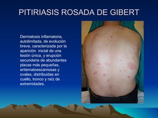 PITIRIASIS ROSADA DE GIBERT Dermatosis inflamatoria, autolimitada, de evolución breve, caracterizada por la aparición  inicial de una lesión única, y erupción secundaria de abundantes placas más pequeñas, eritematoescamosas y ovales, distribuidas en cuello, tronco y raíz de extremidades. 