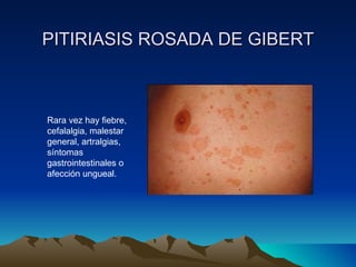 PITIRIASIS ROSADA DE GIBERT Rara vez hay fiebre, cefalalgia, malestar general, artralgias, síntomas gastrointestinales o afección ungueal. 