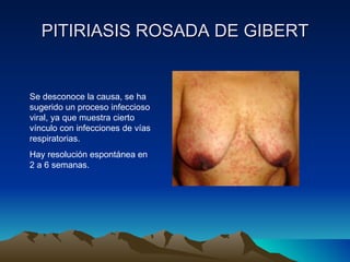 PITIRIASIS ROSADA DE GIBERT Se desconoce la causa, se ha sugerido un proceso infeccioso viral, ya que muestra cierto vínculo con infecciones de vías respiratorias. Hay resolución espontánea en 2 a 6 semanas. 