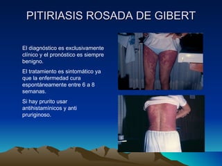 PITIRIASIS ROSADA DE GIBERT El diagnóstico es exclusivamente clínico y el pronóstico es siempre benigno. El tratamiento es sintomático ya que la enfermedad cura espontáneamente entre 6 a 8 semanas. Si hay prurito usar antihistamínicos y anti pruriginoso. 