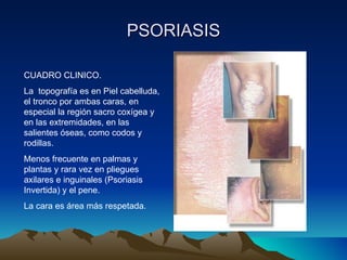 PSORIASIS CUADRO CLINICO. La  topografía es en Piel cabelluda, el tronco por ambas caras, en especial la región sacro coxígea y en las extremidades, en las salientes óseas, como codos y rodillas. Menos frecuente en palmas y plantas y rara vez en pliegues axilares e inguinales (Psoriasis Invertida) y el pene. La cara es área más respetada. 