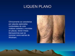 LIQUEN PLANO Clínicamente se caracteriza por pápulas aplanadas romboidales de color violáceo aisladas o reunidas en placas, tienen líneas blanquecinas que se conocen como estrías de Wickham. 