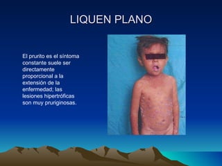 LIQUEN PLANO El prurito es el síntoma constante suele ser directamente proporcional a la extensión de la enfermedad; las lesiones hipertróficas son muy pruriginosas. 