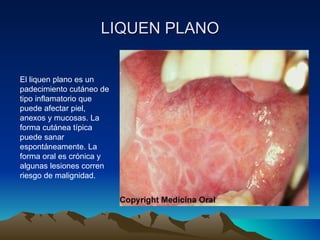 LIQUEN PLANO El liquen plano es un padecimiento cutáneo de tipo inflamatorio que puede afectar piel, anexos y mucosas. La forma cutánea típica puede sanar espontáneamente. La forma oral es crónica y algunas lesiones corren riesgo de malignidad. 