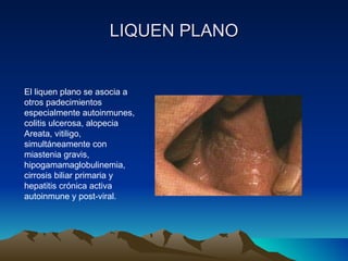 LIQUEN PLANO El liquen plano se asocia a otros padecimientos especialmente autoinmunes, colitis ulcerosa, alopecia Areata, vitiligo, simultáneamente con miastenia gravis, hipogamamaglobulinemia, cirrosis biliar primaria y hepatitis crónica activa autoinmune y post-viral. 