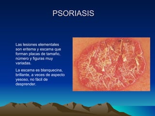PSORIASIS Las lesiones elementales son eritema y escama que forman placas de tamaño, número y figuras muy variadas. La escama es blanquecina, brillante, a veces de aspecto yesoso, no fácil de desprender. 