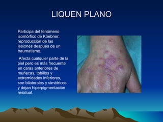 LIQUEN PLANO Participa del fenómeno isomórfico de Köebner: reproducción de las lesiones después de un traumatismo.  Afecta cualquier parte de la piel pero es más frecuente en caras anteriores de muñecas, tobillos y extremidades inferiores, son bilaterales y simétricos y dejan hiperpigmentación residual. 