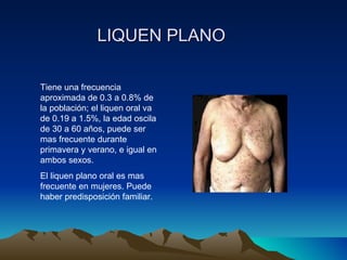 LIQUEN PLANO Tiene una frecuencia aproximada de 0.3 a 0.8% de la población; el liquen oral va de 0.19 a 1.5%, la edad oscila de 30 a 60 años, puede ser mas frecuente durante primavera y verano, e igual en ambos sexos.  El liquen plano oral es mas frecuente en mujeres. Puede haber predisposición familiar. 