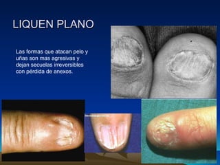 LIQUEN PLANO Las formas que atacan pelo y uñas son mas agresivas y dejan secuelas irreversibles con pérdida de anexos. 