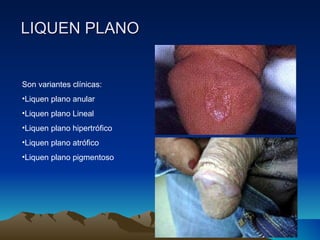 LIQUEN PLANO Son variantes clínicas: Liquen plano anular Liquen plano Lineal Liquen plano hipertrófico Liquen plano atrófico Liquen plano pigmentoso 