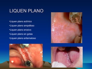 LIQUEN PLANO Liquen plano actínico Liquen plano ampolloso Liquen plano erosivo Liquen plano en gotas Liquen plano eritematoso 