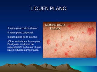 LIQUEN PLANO Liquen plano palmo plantar Liquen plano palpebral Liquen plano de la infancia Otras variedades: liquen plano Penfigoide, síndrome de superposición de liquen y lupus, liquen inducido por fármacos. 