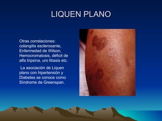 LIQUEN PLANO Otras correlaciones: colangitis esclerosante, Enfermedad de Wilson, Hemocromatosis, déficit de alfa tripsina, uro litiasis etc. La asociación de Liquen plano con hipertensión y Diabetes se conoce como Síndrome de Greenspan. 