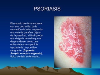 PSORIASIS El raspado de dicha escama con una cucharilla, da la sensación de estar raspando una vela de parafina ( signo de la parafina ), al final queda una delgada laminilla que al desprenderse  como una oblea deja una superficie tapizada de un puntilleo sangrante  ( Signo de Auspitz o rocío sangrante),  típico de ésta enfermedad. 