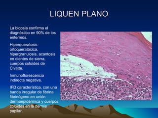 LIQUEN PLANO La biopsia confirma el diagnóstico en 90% de los enfermos. Hiperqueratosis ortoqueratócica, hipergranulosis, acantosis en dientes de sierra, cuerpos coloides de Civatte.  Inmunoflorescencia indirecta negativa. IFD característica, con una banda irregular de fibrina fibrinógeno en unión dermoepidérmica y cuerpos coloides en la dermis papilar. 