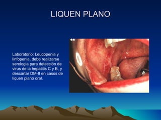 LIQUEN PLANO Laboratorio: Leucopenia y linfopenia, debe realizarse serologia para detección de virus de la hepatitis C y B, y descartar DM-II en casos de liquen plano oral. 