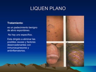 LIQUEN PLANO Tratamiento : es un padecimiento benigno de alivio espontáneo. No hay uno específico. Esta dirigido a eliminar las posibles causas y factores desencadenantes con inmunosupresores y antiinflamatorios. 