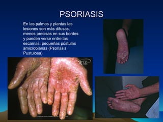PSORIASIS En las palmas y plantas las lesiones son más difusas, menos precisas en sus bordes  y pueden verse entre las escamas, pequeñas pústulas amicrobianas (Psoriasis Pustulosa) 