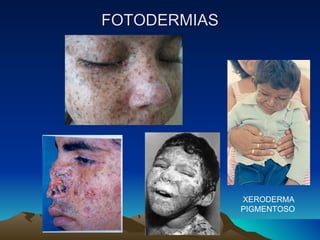 FOTODERMIAS XERODERMA PIGMENTOSO 