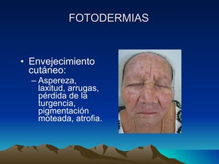 FOTODERMIAS Envejecimiento cut áneo: Aspereza, laxitud, arrugas, p érdida de la turgencia, pigmentación moteada, atrofia. 