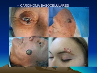 CARCINOMA BASOCELULARES 