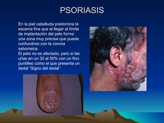 PSORIASIS En la piel cabelluda predomina la escama fina que al llegar al límite de implantación del pelo forma una zona muy precisa que puede confundirse con la corona seborreica. El pelo no es afectado, pero si las uñas en un 30 al 50% con un fino puntilleo como el que presenta un dedal “Signo del dedal” 