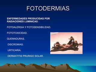 FOTODERMIAS ENFERMEDADES PRODUCIDAS POR RADIACIONES LUMINICAS  : FOTOALERGIA Y FOTOSENSIBILIDAD. FOTOTOXICIDAD. QUEMADURAS. DISCROMIAS. URTICARIA. DERMATITIS PRURIGO SOLAR. 
