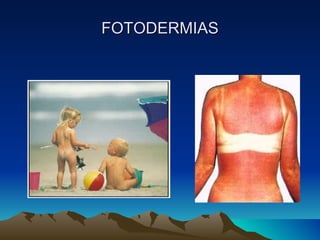 FOTODERMIAS 